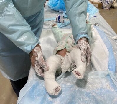 A Ponseti practicioner in Pakistan shows the casts he placed on a clubfoot patient.