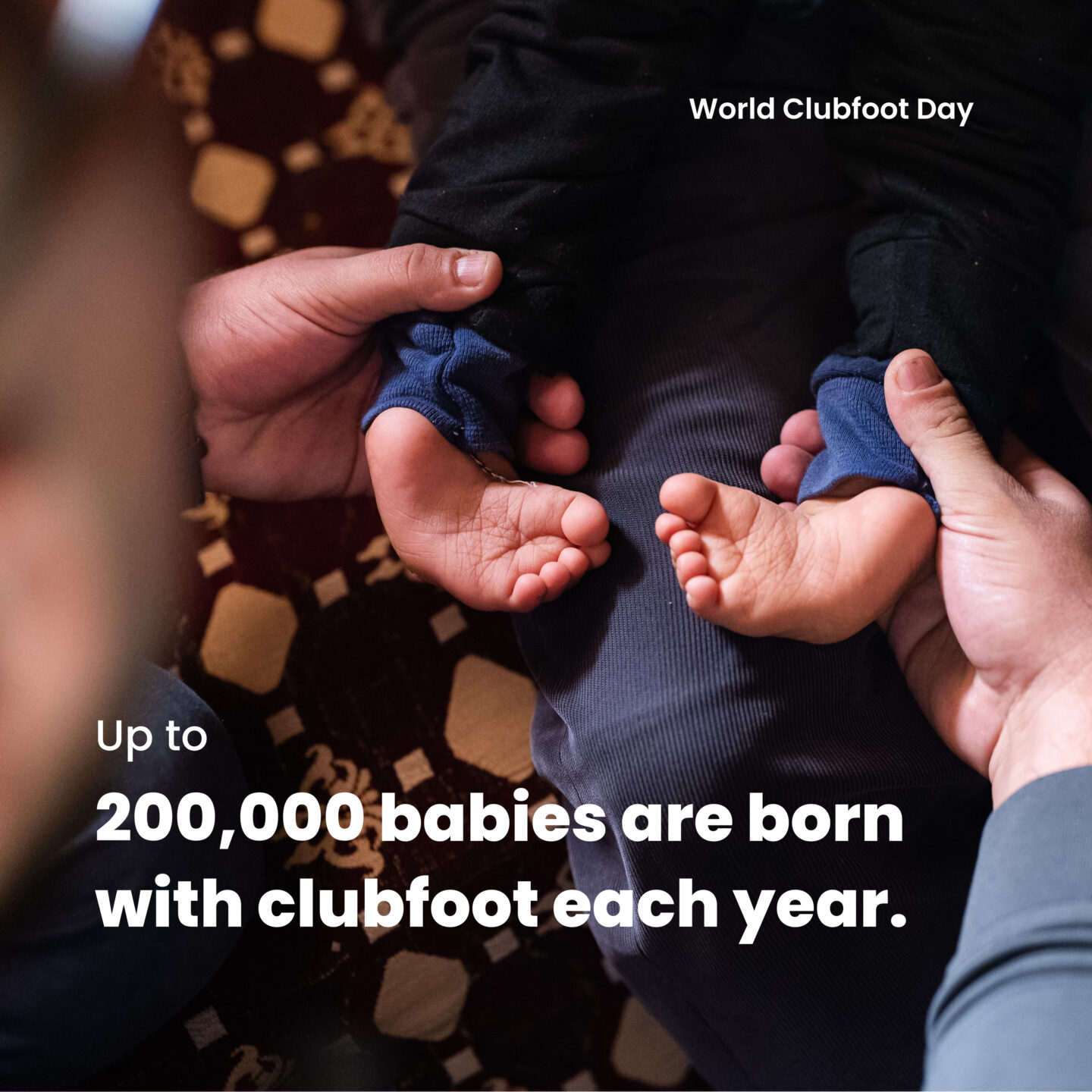 World Clubfoot Day | MiracleFeet