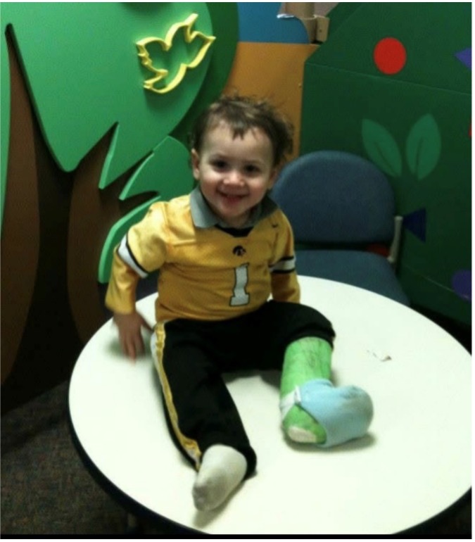 A toddler born with clubfoot wears a cast during clubfoot treatment.